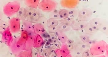 Dernières recommandations concernant le dépistage HPV chez les patientes VIH