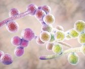 Vulvovaginite candidosique récidivante, diabète et inhibiteurs du cotransporteur sodium-glucose de type 2