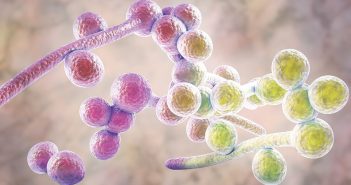 Vulvovaginite candidosique récidivante, diabète et inhibiteurs du cotransporteur sodium-glucose de type 2